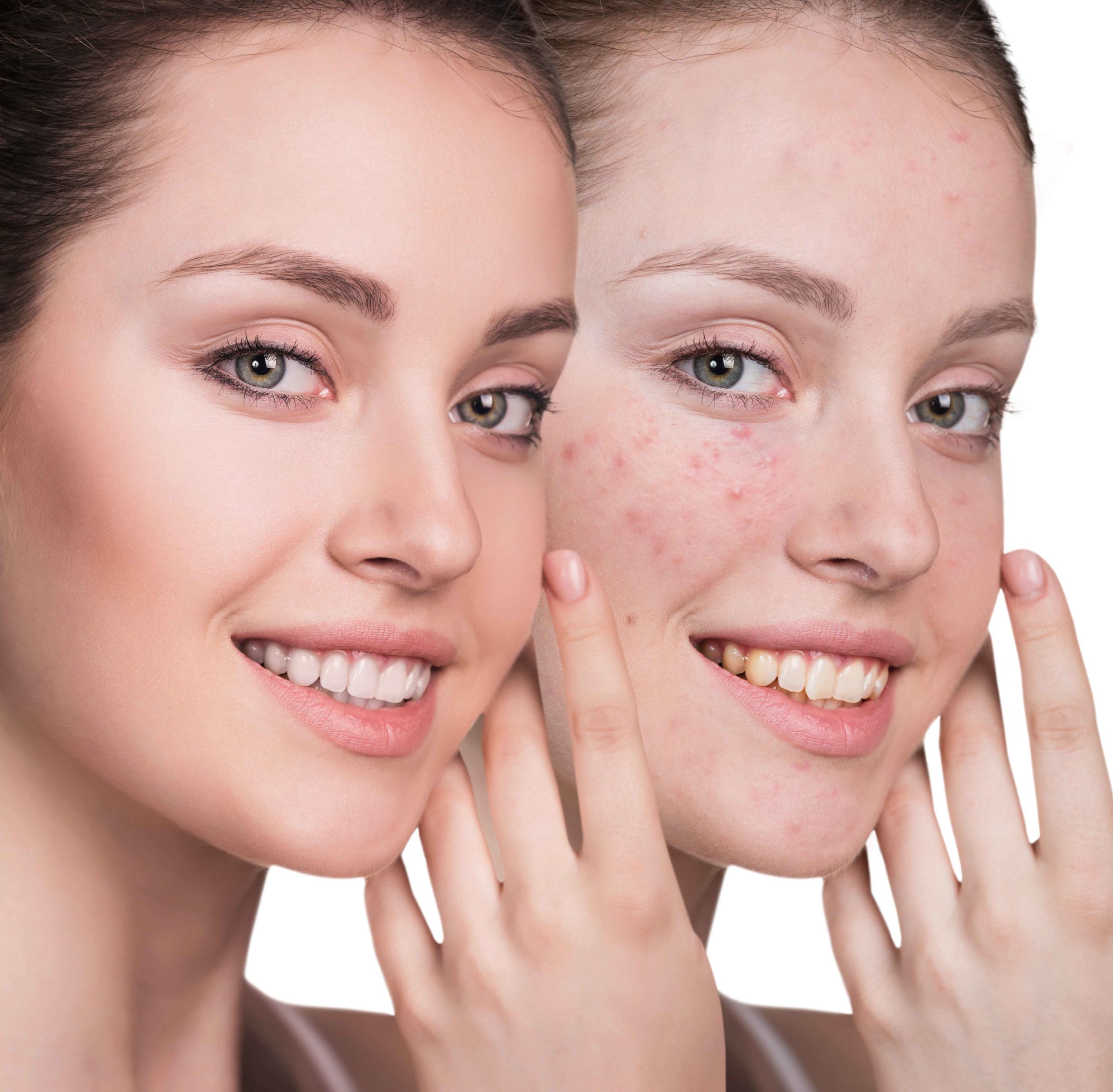 Woman with problem skin on her face