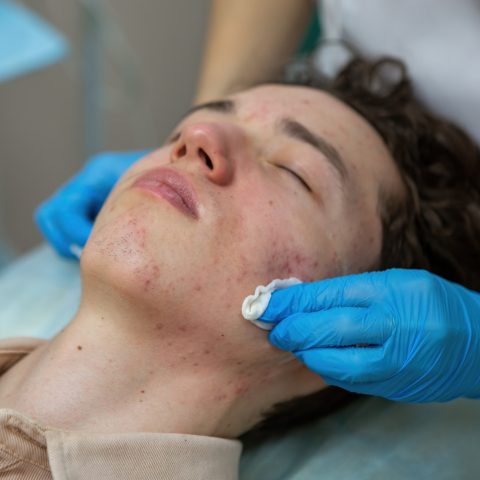 Treatment of acne in adolescents. Facial peeling to fight acne on the face
